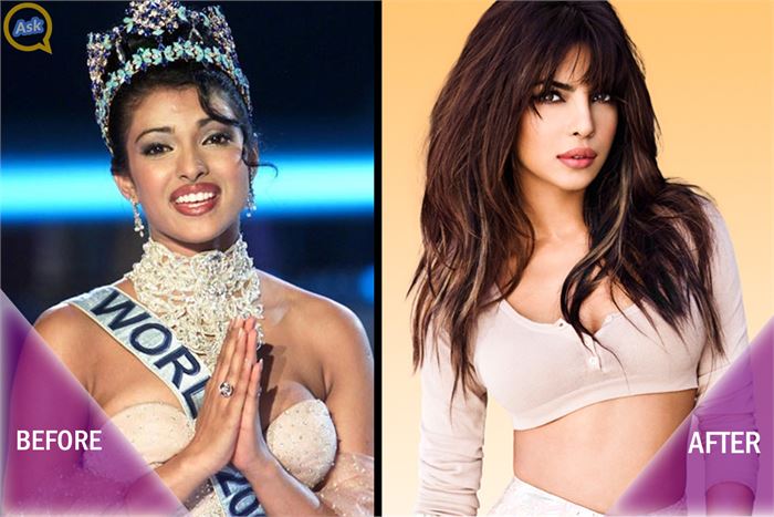 priyanka chopra plastic surgery lips