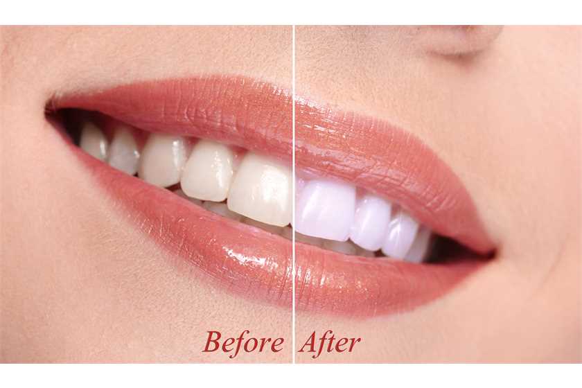 Is teeth shining process harmful for teeth?