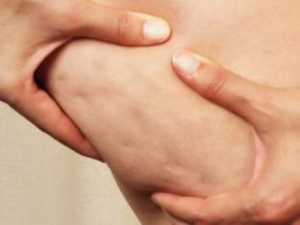 Do you know cellulite can be cured at home?