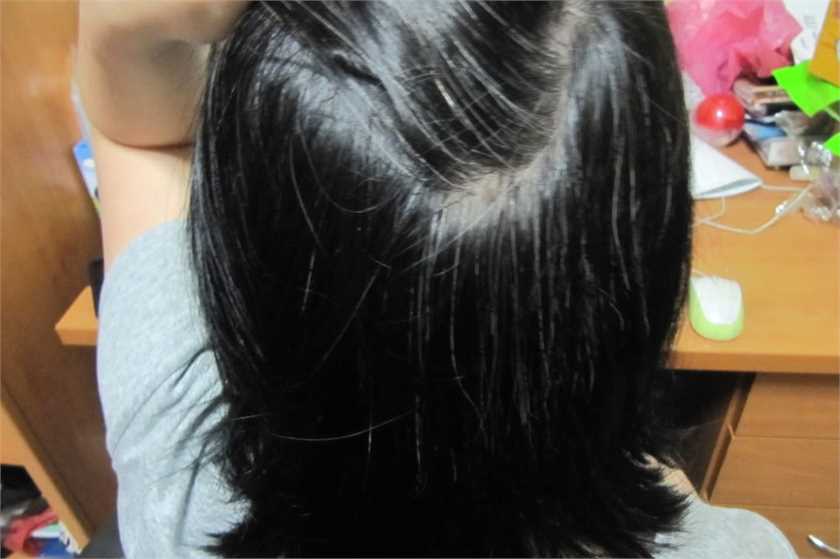 Vitamins That Can Control Premature Graying Of Hair