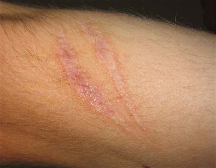 What are treatments for scars?