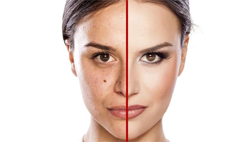 Best natural remedies to remove acne scars 