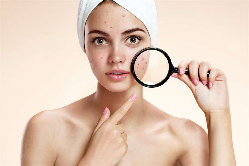 How to get Rid of Acne Overnight?