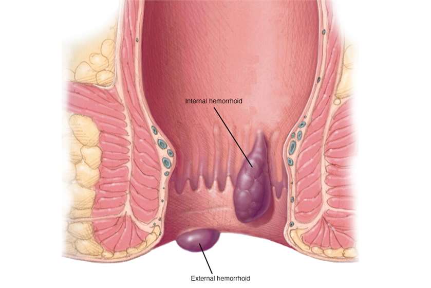 What are Hemorrhoids?