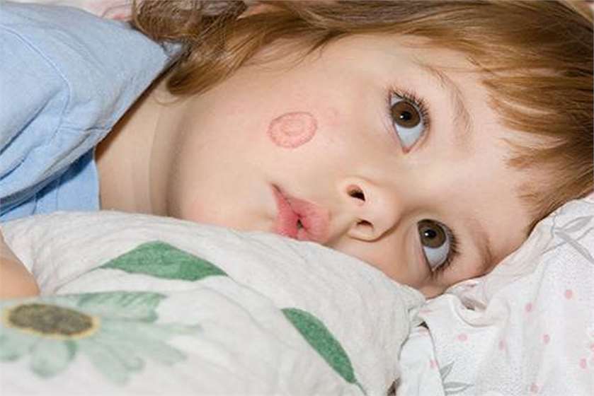 How to Treat Ringworms Effectively?