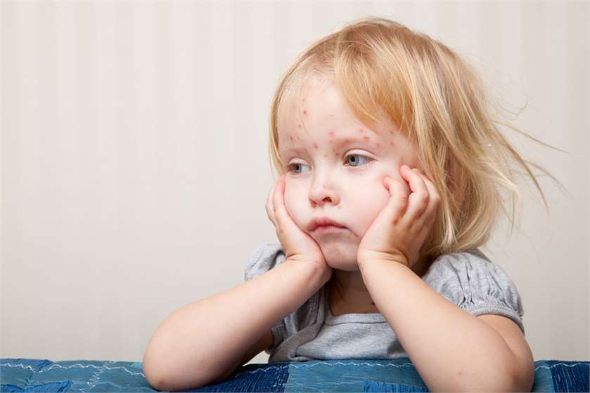 How long does Chickenpox last?