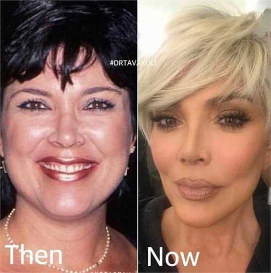 Non surgical chin augmentation